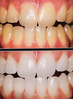 "Minha vida definitivamente mudou após ter feito o clareamento. Resgatei minha auto-estima. É incrível como uma coisa tão simples pode mudar tanto a nossa vida". Miriam Leite (Salvador-BA)