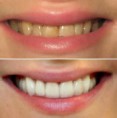 /album/depoimentos/clareamento-dental-jpg/